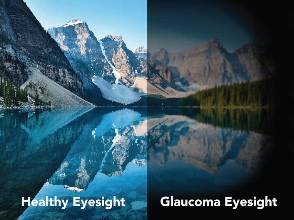 , Glaucoma Awareness Month 2022: What is Glaucoma?, Vold Vision