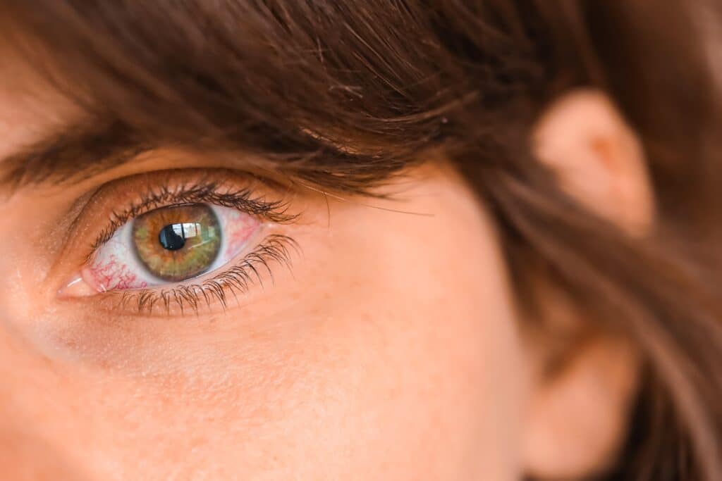 , How is Dry Eye Diagnosed?, Vold Vision