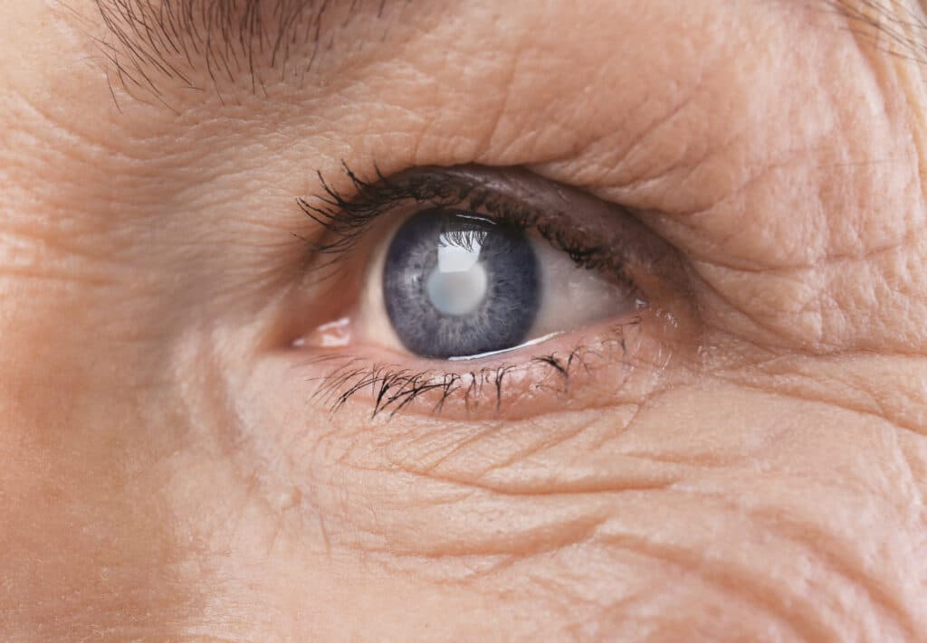 , Glaucoma 101: Causes, Symptoms, and Treatment, Vold Vision