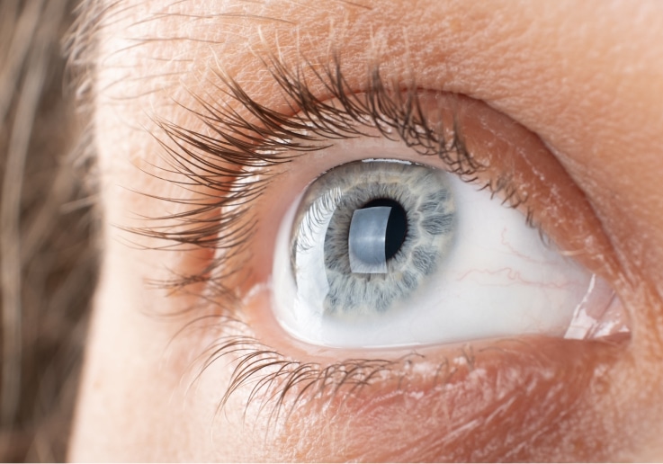 , Cornea Treatments, Vold Vision